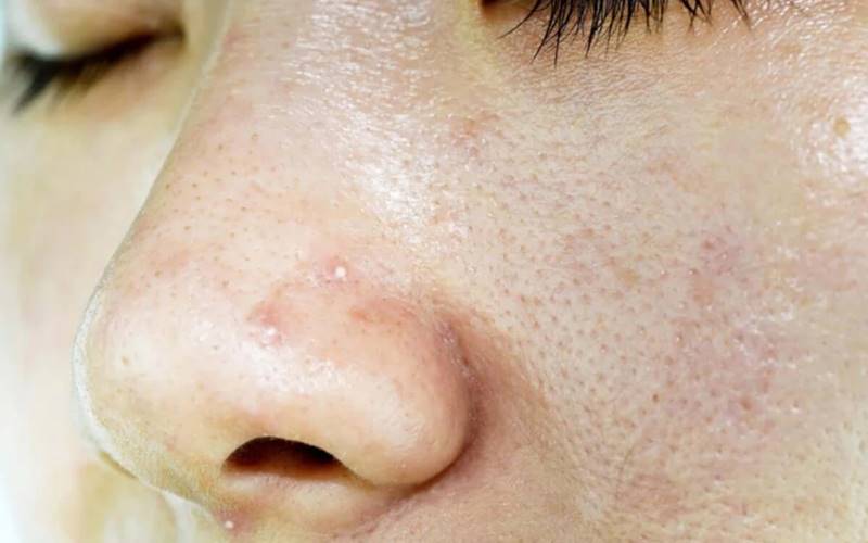 Tại sao cần khắc phục da nhờn?