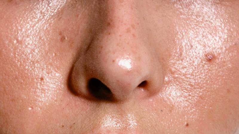 Lưu ý khi áp dụng các cách khắc phục da nhờn