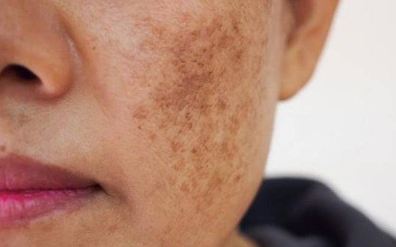 Lời khuyên hữu ích cho da khô sạm