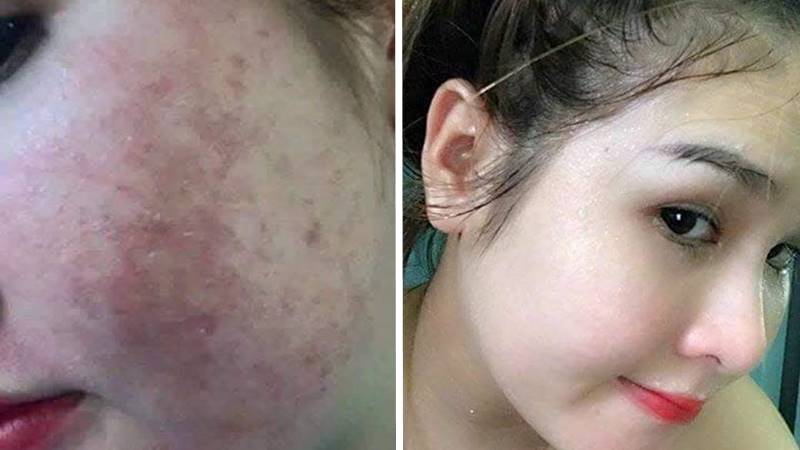 Thuốc bắc tái tạo da - Xu hướng làm đẹp đang gây tranh cãi