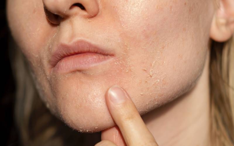 Cách phân biệt da khô và da thiếu nước