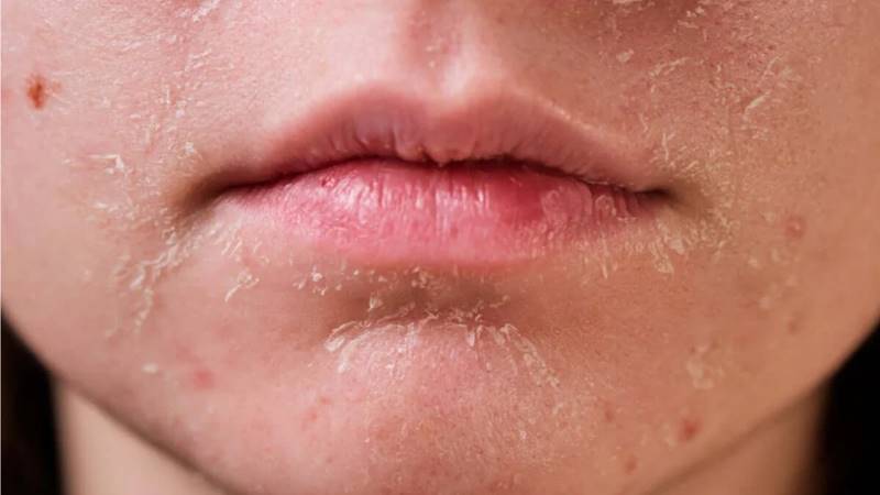 Cách chăm sóc cho làn da thiếu nước