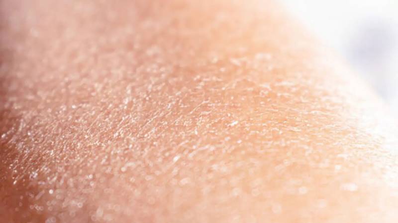 Da khô thường có bề mặt thô ráp, bong tróc và dễ nứt nẻ