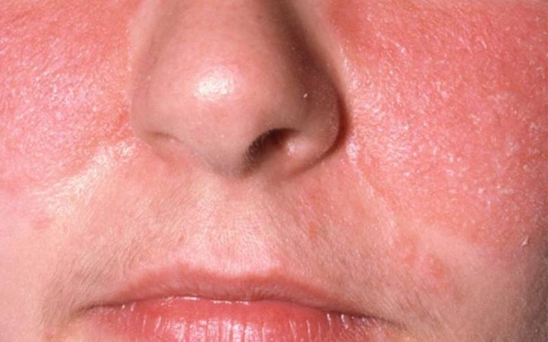 Định nghĩa viêm da tiết bã nhờn
