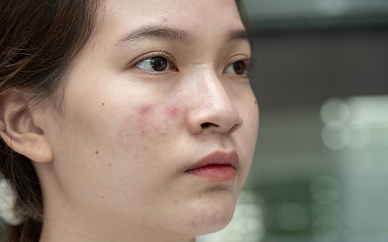 Da bóng nhờn, đặc biệt ở vùng chữ T