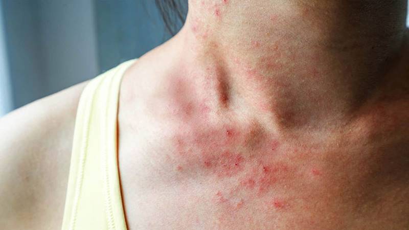 Các phương pháp điều trị tại nhà