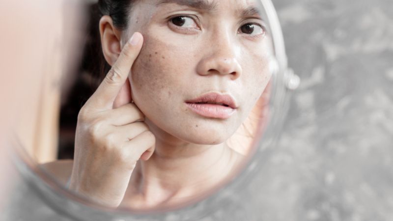 Chứng tăng sắc tố da