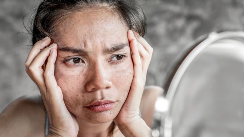 Nguyên nhân gây tăng sắc tố da