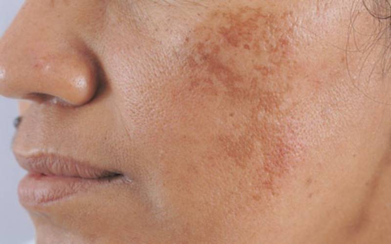 Các loại tăng sắc tố da