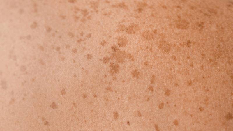 Sử dụng thuốc điều trị tăng sắc tố da mặt
