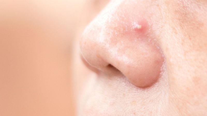Mụn đầu trắng hiếm khi tự khỏi hoàn toàn