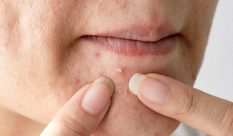 Mụn đầu trắng là gì? Nguyên nhân và cách trị mụn đầu trắng