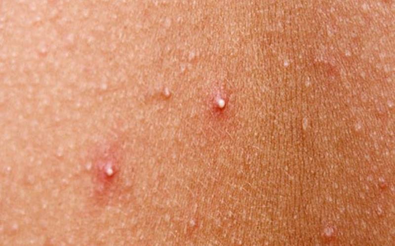Cách điều trị mụn đầu trắng hiệu quả