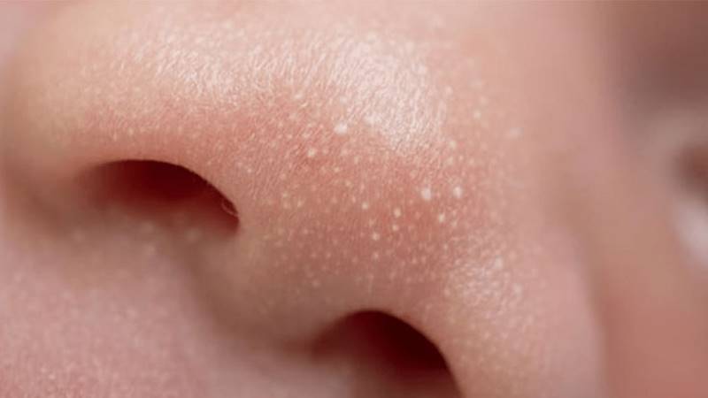 Những lưu ý khi điều trị mụn đầu trắng