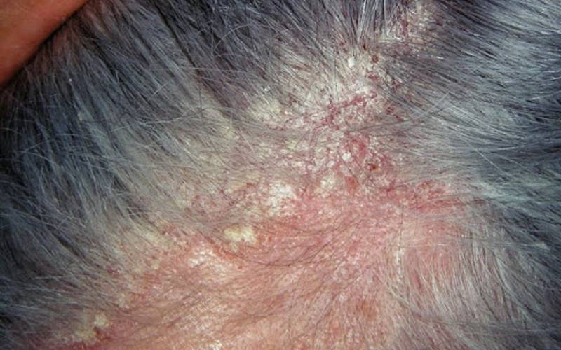 Viêm da tiết bã da đầu là gì? Viêm da tiết bã da đầu là gì?