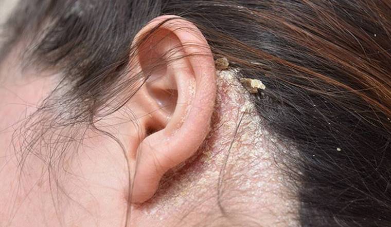 Nguyên nhân và cách trị viêm da tiết bã da đầu