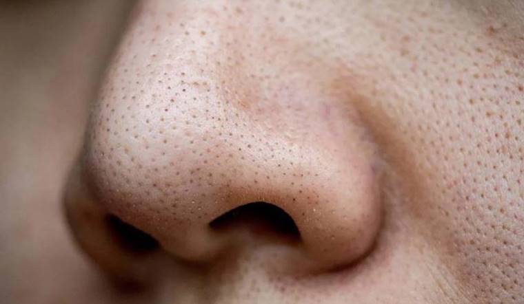 Mụn đầu đen là gì? Nguyên nhân và cách trị mụn đầu đen