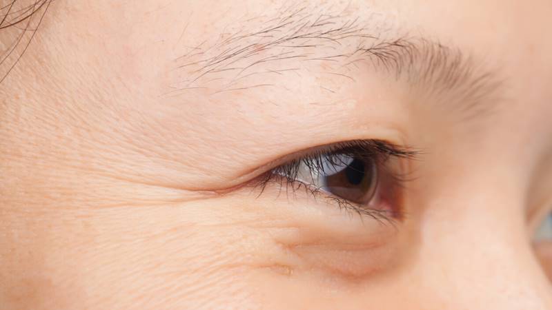 Nếp nhăn là các nếp gấp trên bề mặt da