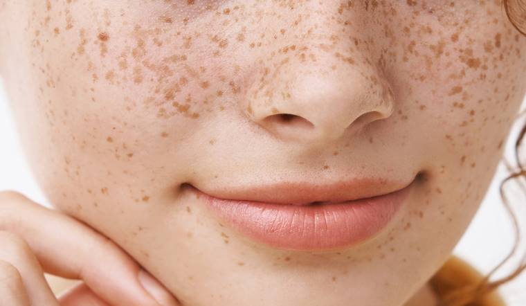 Phân biệt da bị nám và tàn nhang đơn giản: Cách điều trị
