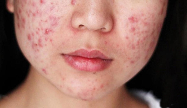 Mụn là gì? Các loại mụn trên mặt thường gặp và cách điều trị