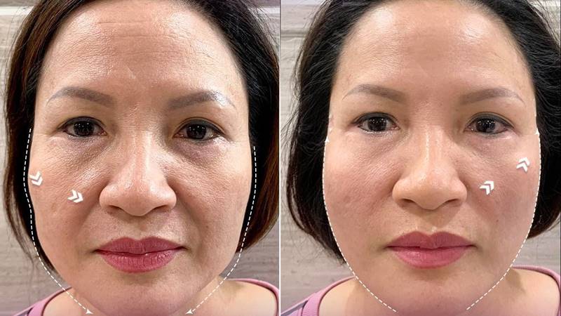 Nguyên nhân khiến da mặt bị chảy xệ