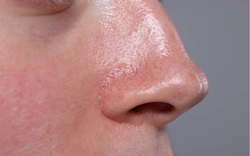 Tại sao một số người có da dầu hơn người khác?