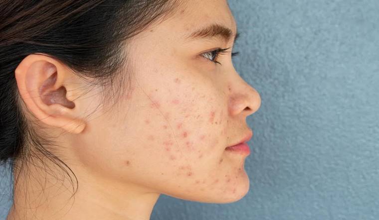 7 tips trị thâm mụn đơn giản, hiệu quả tại nhà
