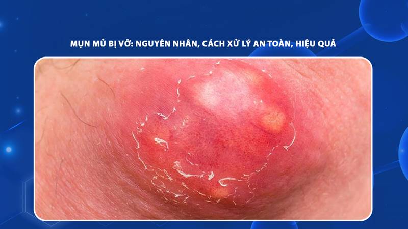 Định nghĩa chi tiết về mụn mủ