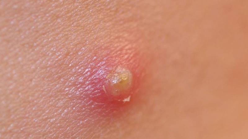 Phân biệt mụn mủ với các loại mụn khác