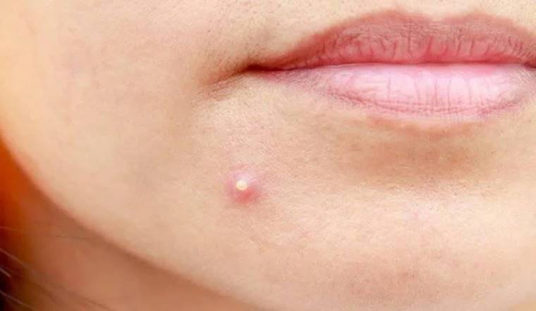 Mụn mủ là gì? Nguyên nhân, dấu hiệu nhận biết và cách điều trị