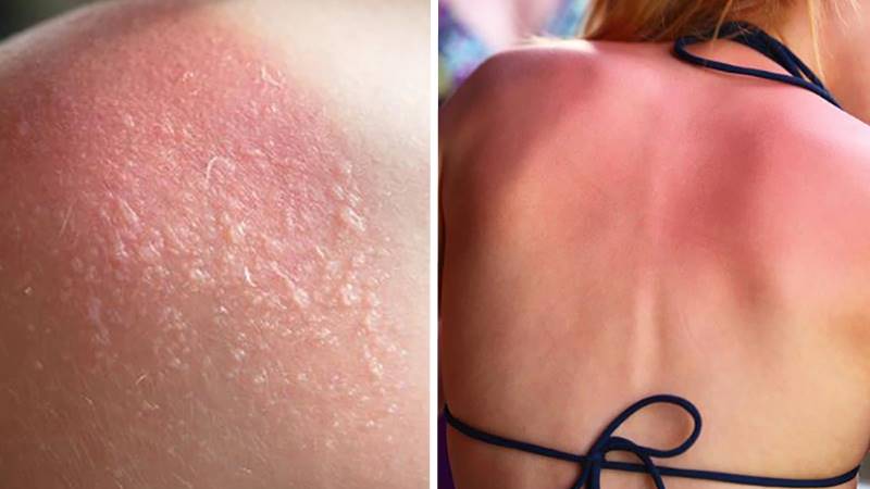 Rửa sạch vùng da bị cháy nắng