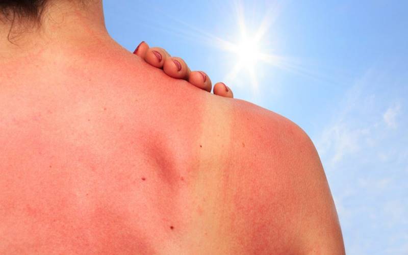Da cháy nắng do nhiều nguyên nhân