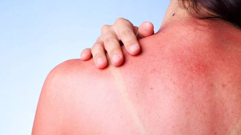 Cách phòng ngừa cháy nắng