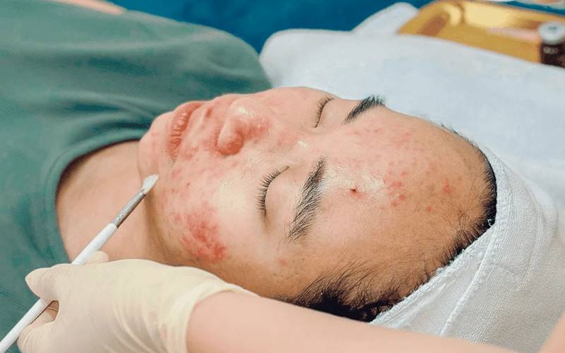 Quy trình peel da trị mụn