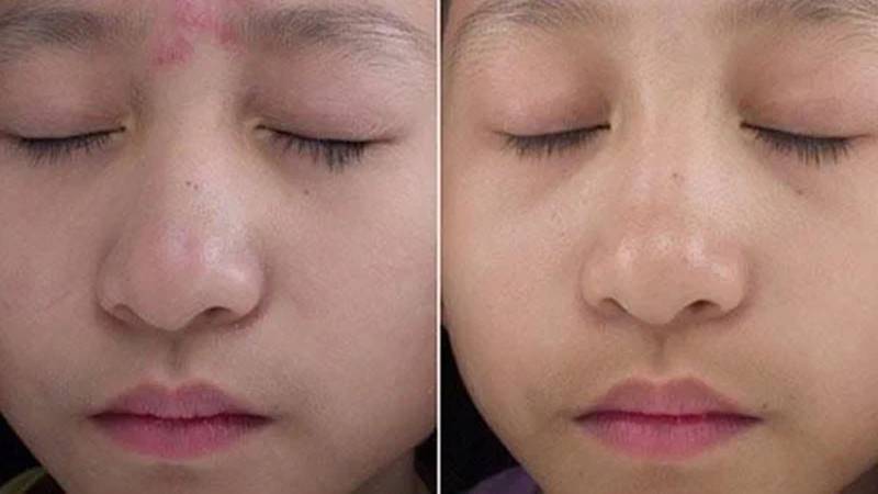 Lợi ích khi peel da trị mụn