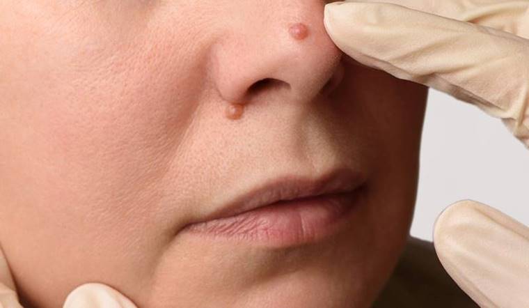 Mụn thịt là gì? Nguyên nhân và dấu hiệu nhận biết mụn thịt