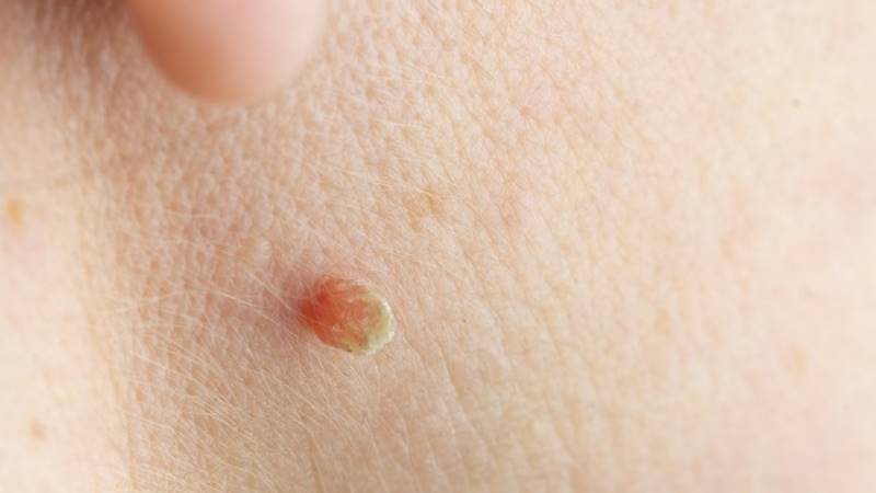 Cách phân biệt mụn thịt với các loại mụn khác