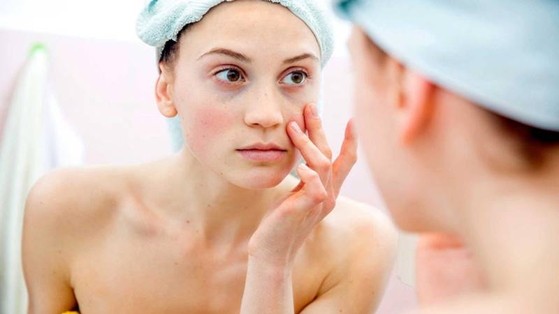 Điều trị mụn cám tại nhà