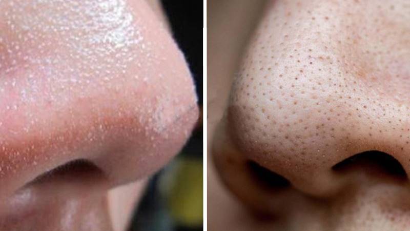 Phân biệt mụn cám với mụn đầu trắng