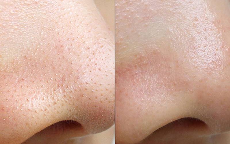 Có nên tự nặn mụn cám không?