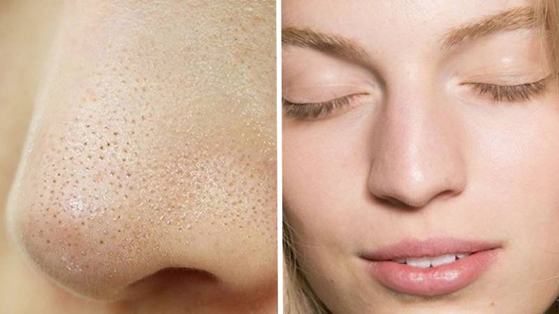 Bản chất của mụn cám