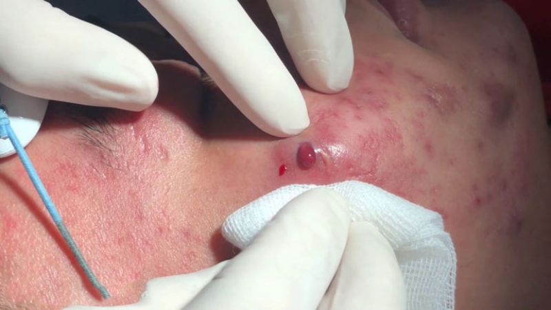 Mụn bọc có máu