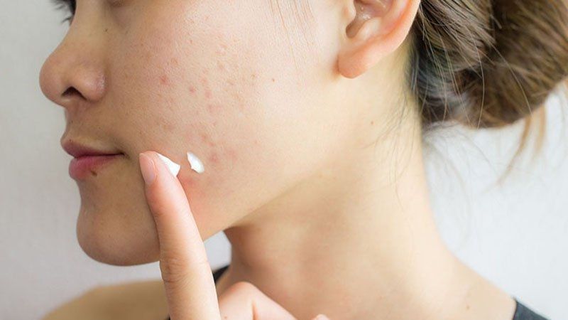 Cách trị mụn bọc nhanh lành