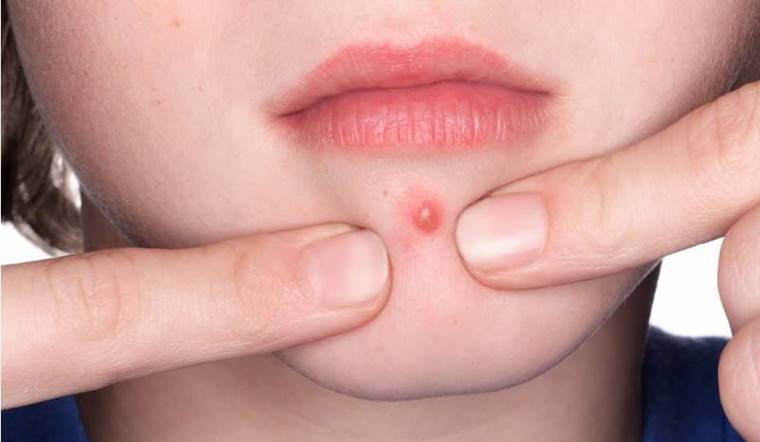 Mụn bọc là gì? Nguyên nhân nổi mụn bọc và cách điều trị