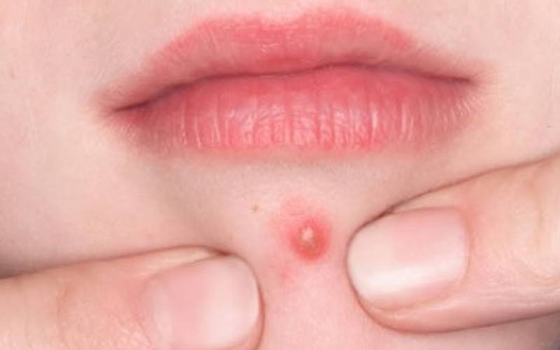 Mụn bọc có mủ