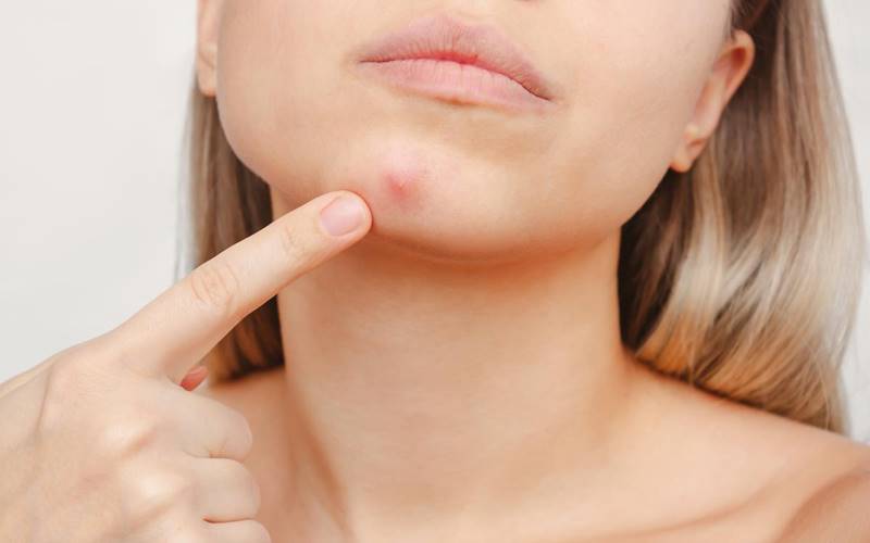 Các giai đoạn tiến triển của mụn bọc