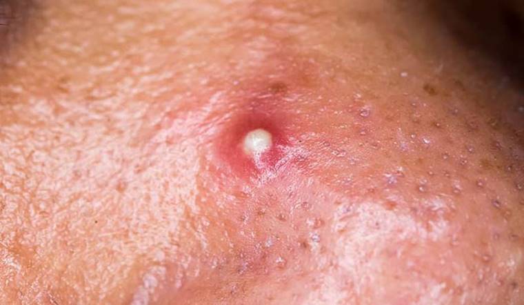 Mụn đầu đinh có nguy hiểm không? Nhận biết và cách điều trị