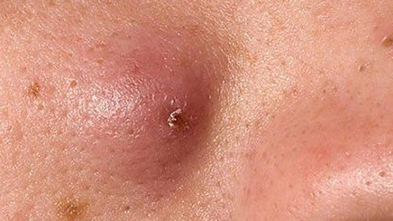 Mức độ nguy hiểm của mụn đầu đinh