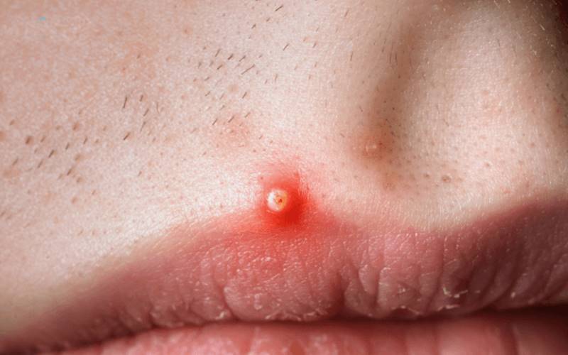 Nhận biết mụn đầu đinh