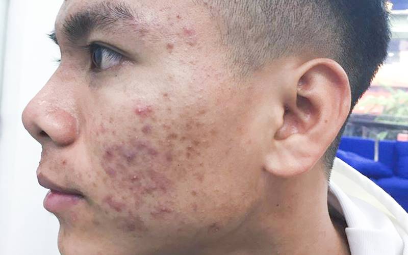 Nguyên nhân gây nổi mụn viêm